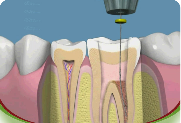Instrumentacion endodoncia