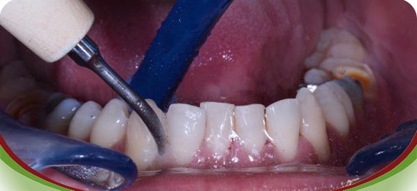 Eliminación del sarro dental por medio de ultrasonidos.