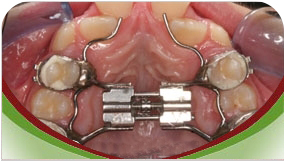 ortodoncia aparatos expansores