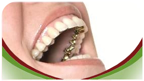 ortodoncia lingual invisible